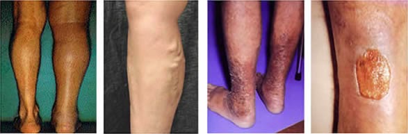Περιφερική αγγειακή αρτηριακή νόσος, αποφρακτική αρτηριοπάθεια, με χωλότητα, πόνο, κράμπες, πληγές, μούδιασμα στα πόδια - Φωτογραφία 2