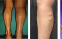 Περιφερική αγγειακή αρτηριακή νόσος, αποφρακτική αρτηριοπάθεια, με χωλότητα, πόνο, κράμπες, πληγές, μούδιασμα στα πόδια - Φωτογραφία 2