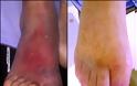 Περιφερική αγγειακή αρτηριακή νόσος, αποφρακτική αρτηριοπάθεια, με χωλότητα, πόνο, κράμπες, πληγές, μούδιασμα στα πόδια - Φωτογραφία 3
