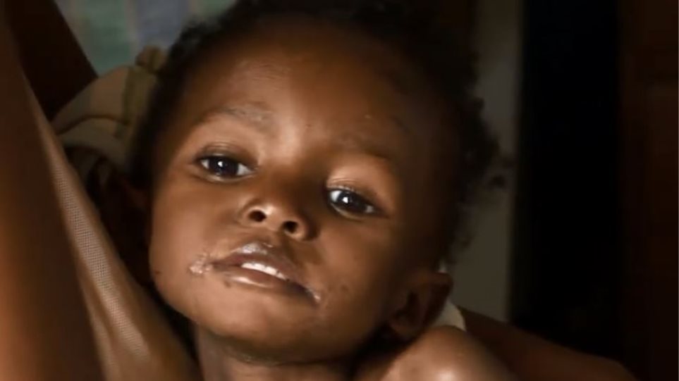 Από πείνα οι μισοί θάνατοι παιδιών στην Αφρική - Φωτογραφία 1