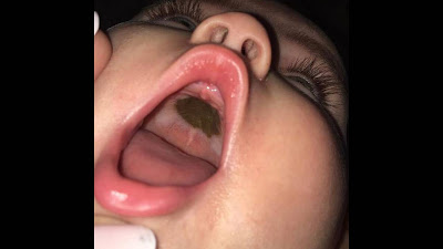 Είδε αυτό το σημάδι στο στόμα του μωρού της και πανικοβλήθηκε - Φωτογραφία 1
