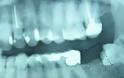 Ένα δόντι μεγάλωνε γεννητικά όργανα - Φωτογραφία 1