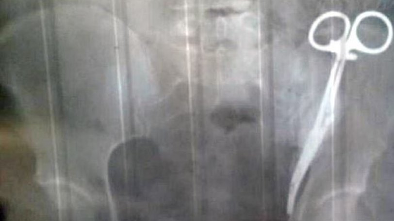 Μία 62χρονη είχε για 23 χρόνια ξεχασμένο στην κοιλιά της ένα χειρουργικό ψαλίδι - Φωτογραφία 1
