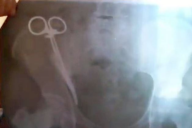 Μία 62χρονη είχε για 23 χρόνια ξεχασμένο στην κοιλιά της ένα χειρουργικό ψαλίδι - Φωτογραφία 3