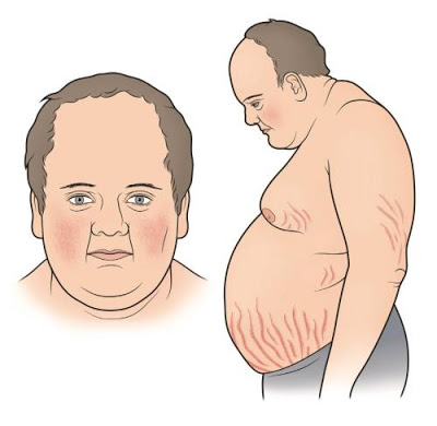 Σύνδρομο Cushing, με αύξηση βάρους, εύκολη κόπωση, υπέρταση, διαβήτη, αγχώδεις διαταραχές - Φωτογραφία 1