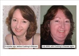 Σύνδρομο Cushing, με αύξηση βάρους, εύκολη κόπωση, υπέρταση, διαβήτη, αγχώδεις διαταραχές - Φωτογραφία 4