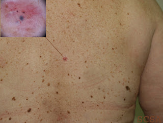 Βασικοκυτταρικό Καρκίνωμα, η πιο συνηθισμένη μορφή καρκίνου του δέρματος (φωτο) - Φωτογραφία 4