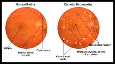 Μήπως ο διαβήτης έχει βλάψει τα μάτια σας; Διαβητική οφθαλμοπάθεια, διαβητική αμφιβληστροειδοπάθεια (video) - Φωτογραφία 2
