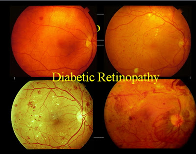 Μήπως ο διαβήτης έχει βλάψει τα μάτια σας; Διαβητική οφθαλμοπάθεια, διαβητική αμφιβληστροειδοπάθεια (video) - Φωτογραφία 3