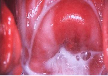Αιτίες και συμπτώματα των γυναικολογικών λοιμώξεων του καλοκαιριού - Φωτογραφία 3