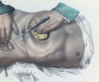 Πώς γίνονταν οι χειρουργικές επεμβάσεις το 1840 - ΣΥΓΚΛΟΝΙΣΤΙΚΕΣ εικόνες από χειρουργεία ΧΩΡΙΣ ΑΝΑΙΣΘΗΤΙΚΟ... [photos] - Φωτογραφία 1
