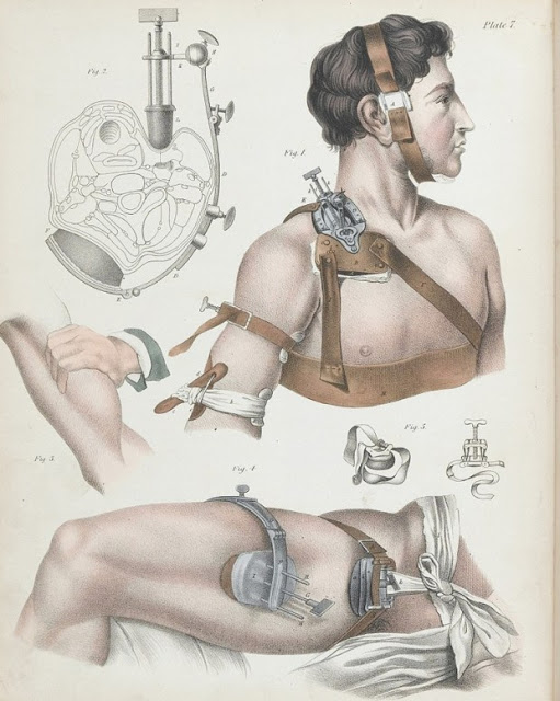 Πώς γίνονταν οι χειρουργικές επεμβάσεις το 1840 - ΣΥΓΚΛΟΝΙΣΤΙΚΕΣ εικόνες από χειρουργεία ΧΩΡΙΣ ΑΝΑΙΣΘΗΤΙΚΟ... [photos] - Φωτογραφία 3