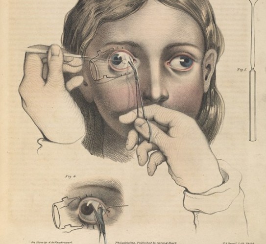 Πώς γίνονταν οι χειρουργικές επεμβάσεις το 1840 - ΣΥΓΚΛΟΝΙΣΤΙΚΕΣ εικόνες από χειρουργεία ΧΩΡΙΣ ΑΝΑΙΣΘΗΤΙΚΟ... [photos] - Φωτογραφία 5