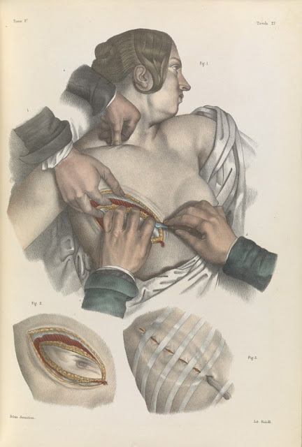 Πώς γίνονταν οι χειρουργικές επεμβάσεις το 1840 - ΣΥΓΚΛΟΝΙΣΤΙΚΕΣ εικόνες από χειρουργεία ΧΩΡΙΣ ΑΝΑΙΣΘΗΤΙΚΟ... [photos] - Φωτογραφία 8