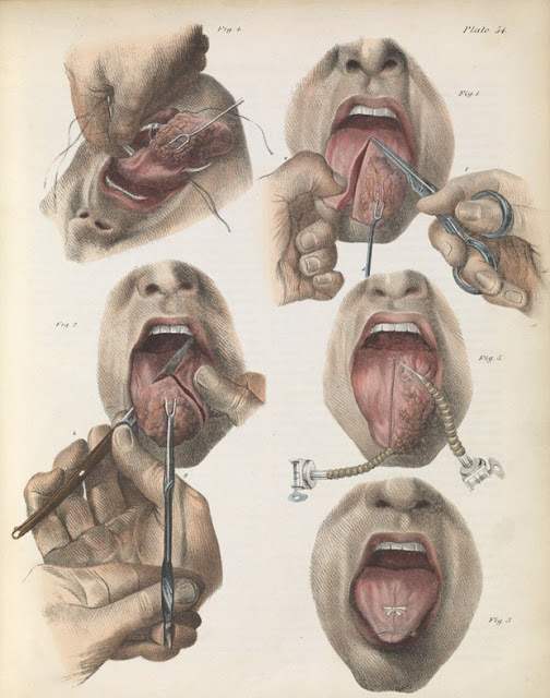 Πώς γίνονταν οι χειρουργικές επεμβάσεις το 1840 - ΣΥΓΚΛΟΝΙΣΤΙΚΕΣ εικόνες από χειρουργεία ΧΩΡΙΣ ΑΝΑΙΣΘΗΤΙΚΟ... [photos] - Φωτογραφία 9