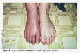 Αλγοδυστροφία, σύνδρομο σύμπλοκου περιοχικού πόνου με πόνο και αίσθημα καψίματος σε πόδια ή χέρια - Φωτογραφία 3