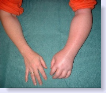 Αλγοδυστροφία, σύνδρομο σύμπλοκου περιοχικού πόνου με πόνο και αίσθημα καψίματος σε πόδια ή χέρια - Φωτογραφία 4