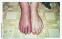 Αλγοδυστροφία, σύνδρομο σύμπλοκου περιοχικού πόνου με πόνο και αίσθημα καψίματος σε πόδια ή χέρια - Φωτογραφία 3