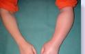 Αλγοδυστροφία, σύνδρομο σύμπλοκου περιοχικού πόνου με πόνο και αίσθημα καψίματος σε πόδια ή χέρια - Φωτογραφία 4