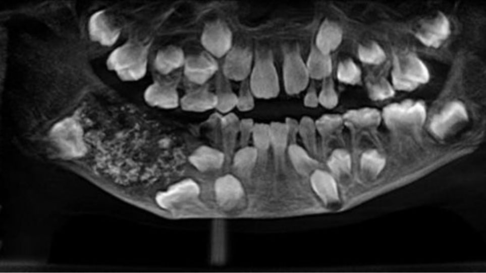 Γιατροί έβγαλαν 526 δόντια από το στόμα ενός 7χρονου - Φωτογραφία 1