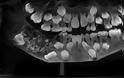 Γιατροί έβγαλαν 526 δόντια από το στόμα ενός 7χρονου