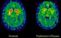 Τρέμουν τα χέρια σας; Oφείλεται στη νόσο Parkinson ή σε ιδιοπαθή τρόμο; - Φωτογραφία 4