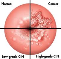 Πως αναπτύσσεται ο καρκίνος της μήτρας; Η σημασία της πρόληψης και του τεστ ΠΑΠ - Φωτογραφία 3