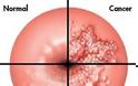 Πως αναπτύσσεται ο καρκίνος της μήτρας; Η σημασία της πρόληψης και του τεστ ΠΑΠ - Φωτογραφία 3
