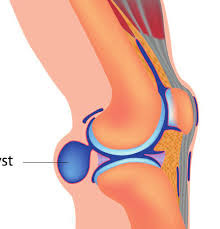 Πόνος στο γόνατο από ιγνυακή κύστη, κύστεις του baker - Φωτογραφία 2