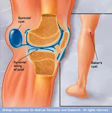 Πόνος στο γόνατο από ιγνυακή κύστη, κύστεις του baker - Φωτογραφία 3