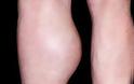 Πόνος στο γόνατο από ιγνυακή κύστη, κύστεις του baker - Φωτογραφία 4