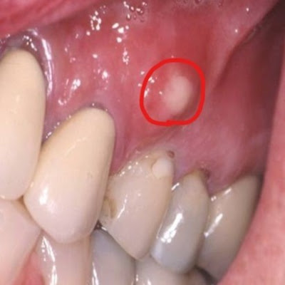 Στοματικό απόστημα, μια δυσάρεστη διόγκωση στο στόμα ή και στο πρόσωπο - Φωτογραφία 1