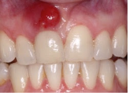 Στοματικό απόστημα, μια δυσάρεστη διόγκωση στο στόμα ή και στο πρόσωπο - Φωτογραφία 4
