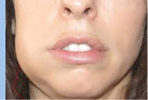 Στοματικό απόστημα, μια δυσάρεστη διόγκωση στο στόμα ή και στο πρόσωπο - Φωτογραφία 5