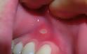 Στοματικό απόστημα, μια δυσάρεστη διόγκωση στο στόμα ή και στο πρόσωπο - Φωτογραφία 2