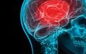 Εγκεφαλικό: Αυτά είναι τα συμπτώματα – Βασικός οδηγός για όλους (video)