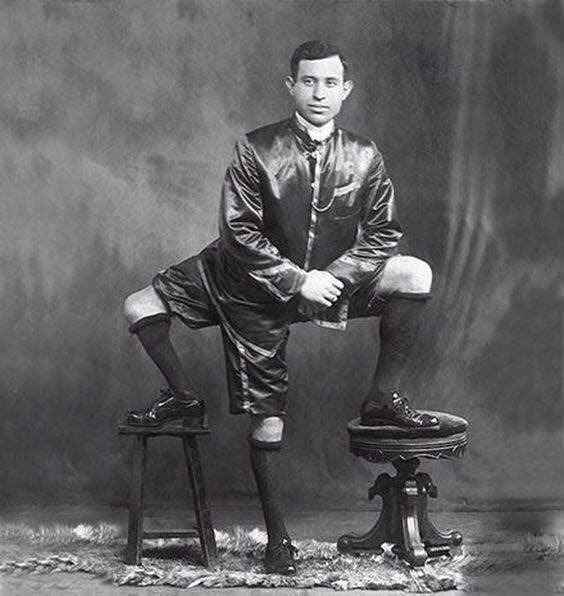Francesco Lentini: Ο άνδρας με τα τρία πόδια και τα δύο γεννητικά όργανα! - Φωτογραφία 1
