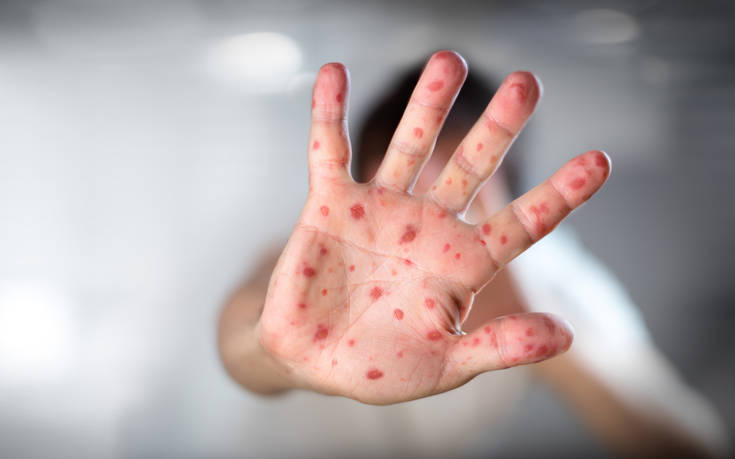 Έξαρση των επιδημιών ιλαράς στην Ευρώπη -Επανεμφανίστηκε στην Ελλάδα - Φωτογραφία 1