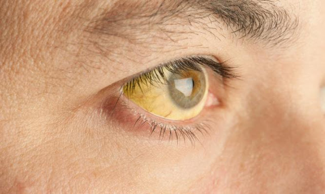 Κίτρινα μάτια: Ποιο πρόβλημα υγείας «μαρτυρούν» - Ποιοι πρέπει να προσέχουν - Φωτογραφία 1