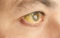 Κίτρινα μάτια: Ποιο πρόβλημα υγείας «μαρτυρούν» - Ποιοι πρέπει να προσέχουν