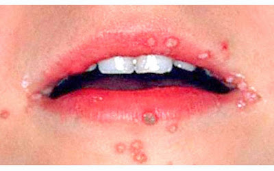 Οι HPV ιοί ανιχνεύονται σε ποσοστό 35-45% στο στόμα - Φωτογραφία 1