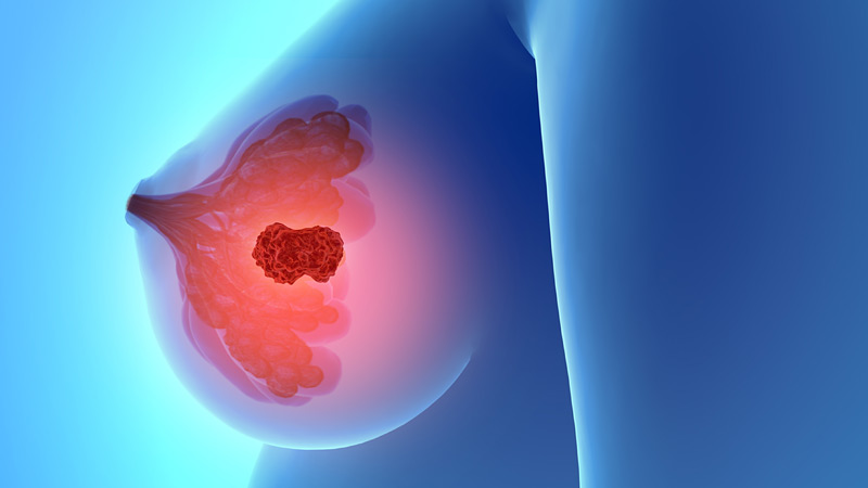 H πρώτη ανοσοθεραπεία για τον τριπλά αρνητικό καρκίνο του μαστού - Φωτογραφία 1
