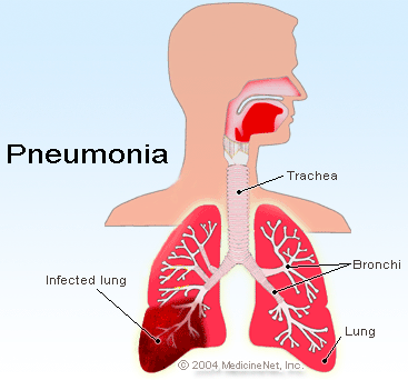 Τι είναι η Πνευμονία ποιοι οι τύποι της, ποια τα συμπτώματα; Πρόληψη της πνευμονίας; - Φωτογραφία 3