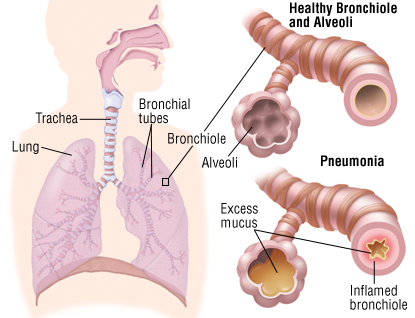 Τι είναι η Πνευμονία ποιοι οι τύποι της, ποια τα συμπτώματα; Πρόληψη της πνευμονίας; - Φωτογραφία 6