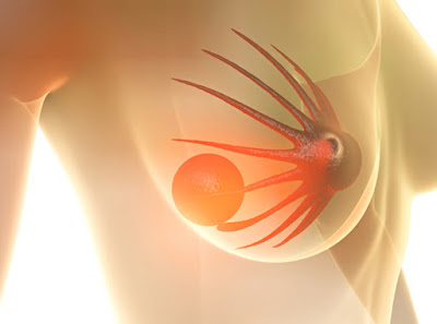 Έρευνα αποδεικνύει την αποτελεσματικότητα της ριμποσικλίμπης στον προχωρημένο καρκίνο του μαστού. - Φωτογραφία 1