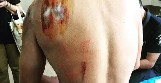 Σοβαρά τραυματίας ποδηλάτης αστυνομικός μετά από επίθεση σκύλου στη Λυσιμαχία (φωτο) - Φωτογραφία 1