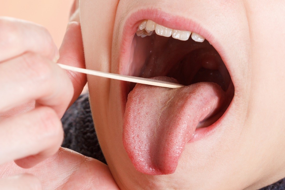 Έρευνα για την πρόγνωση μεταστάσεων του ακανθοκυτταρικού καρκίνου του στόματος - Φωτογραφία 1