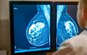 Η σημασία της έγκαιρης διάγνωσης στον καρκίνο του μαστού. Εγκυμοσύνη και θηλασμός μετά από μαστεκτομή - Φωτογραφία 3