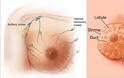 Η σημασία της έγκαιρης διάγνωσης στον καρκίνο του μαστού. Εγκυμοσύνη και θηλασμός μετά από μαστεκτομή - Φωτογραφία 4