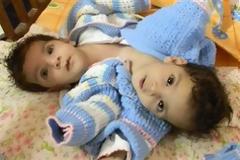 Διαχωρίστηκαν επιτυχώς σιαμαία κοριτσάκια στην Ινδία